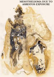 mesothelioma.jpg 03-Aug-2008