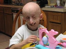 affected by Progeria are