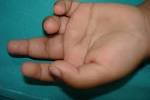 <b>Juvenile Rheumatoid Arthritis</b>