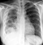 <b>mesothelioma</b> 4