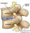 HERNIATED DISC Treatment in Miami and Hialeah | Dynamic Medical ...
