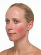<b>rosacea</b> treatment