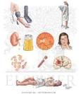 PreECLAMPSIA / ECLAMPSIA - Netter Medical Illustrations