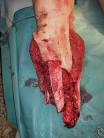 <b>Traumatic amputation</b> of lower