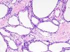 <b>serous cystadenoma</b> (1).jpg