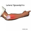 known as <b>tennis elbow</b>,