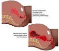 Jatropha to cope with <b>retained placenta</b> | Health with Natural Remedies