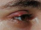 Know about Swollen <b>Eyelid</b>
