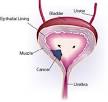 <b>Urinary Bladder Cancer</b>