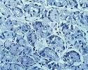 <b>Stromatumörer</b> i <b>livmoderslemhinnan</b> www.lookfordiagnosis.com
