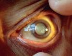White <b>cataract</b>