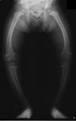 old <b>rickets</b> sufferer,