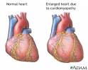 HEART TRANSPLANT - Series - Wake Forest Baptist Medical Center
