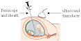 Storz Rigid TTTS <b>Fetoscopy</b>