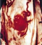 <b>Neoplasms</b> of the Spinal Cord and Filum Terminale: Radiologic