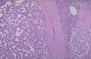 The <b>islet cell adenoma</b> at the