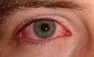 <b>Eye Infections</b> Fungal