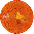 About Wet Macular Degeneration