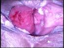 Tumeurs De La <b>Vulve</b>; cancer de la <b>vulve</b>; cancer vulvaire; tumeurs
