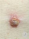 Clear Cell <b>Acanthoma</b> Degos