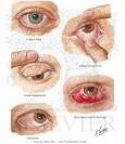 <b>Eyelid</b> Infection and