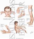 Ehlers-Danlos Syndrome - Netter Medical Artwork