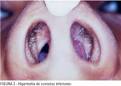Facial - <b>Nasal</b> obstruction