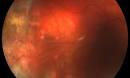 <b>Acute Retinal Necrosis</b>