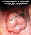 :o. anomalie. indice