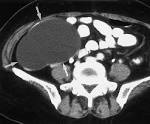 Benign <b>serous cystadenoma</b> in a