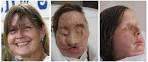 Face Transplant: New Life for Charla Nash Before And After [