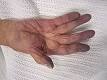 <b>Cyanosis</b> of the hand in