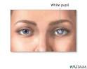 Pupil - white spots
