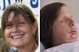 Charla Nash Face Transplant Revealed After Chimapanzee Attack ...