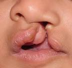 Sneha Mary. Unilateral Cleft Lip & Palate - 000