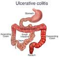 ulcerative colitis pronunciation