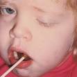 <b>Kearns</b>–<b>sayre syndrome</b>
