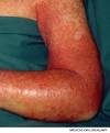 axillary vein <b>thrombosis</b>.