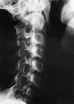 <b>Ossification</b> of the <b>posterior</b>