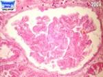 <b>Necrose</b> Isquêmica 12.jpg