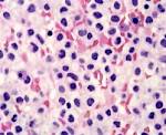 Acute <b>leukemia</b> is curable one.