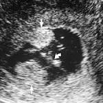 Prediction of Benign and Malignant <b>Endometrial</b> Disease