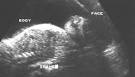 Ultrasound Section Featured Article: Exencephaly-ANENCEPHALY Sequence