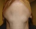 <b>Submandibular gland disease</b>
