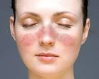 <b>Lupus</b> is an autoimmune