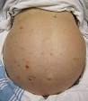 <b>ascites</b> and caput medusae