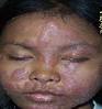Oleh Hasan Zainuddin Banjarmasin, 2/3 (ANTARA)- Beberapa jenis penyakit yang ... - leprosy31