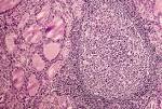 Hashimoto is an <b>autoimmune</b>