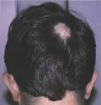 <b>Alopecia Areata</b> is a skin