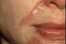 New treatments for <b>Cicatrix</b>